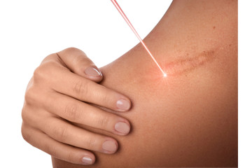 Odstranění jizev a strií