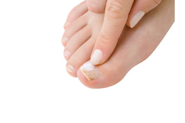 Léčba onychomykózy