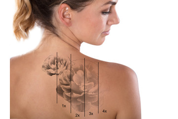 Odstranění tetování